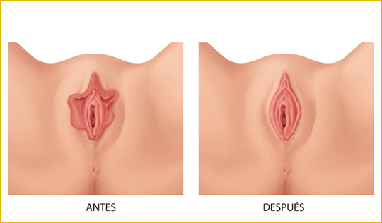 Rejuvenecimiento vaginal sin cirugias rejuvenecimiento-vaginal-antes-y-despues